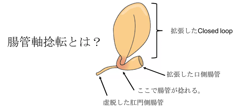 画像あり】S状結腸軸捻転とは？原因、症状、CT、治療まとめ！